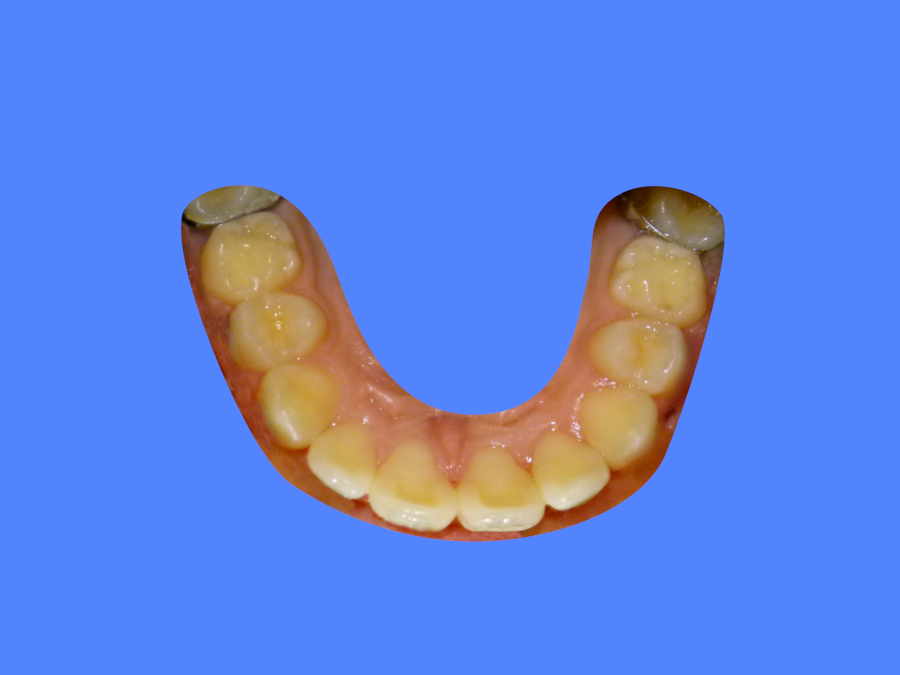 Before image with patient showing misaligned teeth